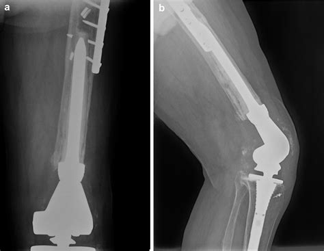 Tapered Modular Fluted Titanium Stems For Femoral Fixation In Revision