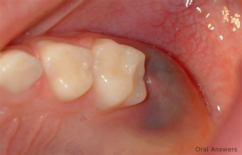 Pediatric Dentistry Oral Answers