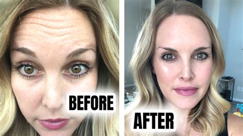 botox before and after 8 day progression post pregnancy youtube