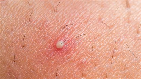 What Causes Ingrown Hairs And What Treatments Are There
