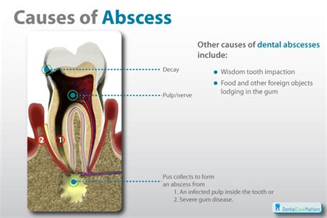 Calling them a tooth or gum abscess is simpler terminology for a mouth abscess, but to dentists and dental professional who actually treat the abscess for you, they. Periodontal Abscess - Causes, Symptoms and Treatment ...