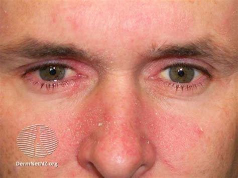 Seborrheic Dermatitis Vs Rosacea Similarities And Differences