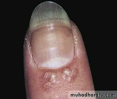 Nail Disorders Pptx Omer Y Abdullah Muhadharaty