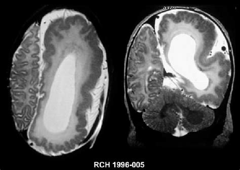 Imaging Features Of Hemimegalencephaly Axial T2 Wieghted Mri Left