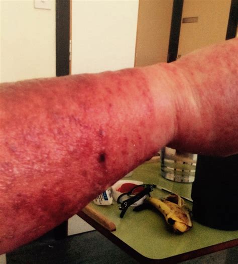 Allergic Reaction To Medicine Leaves Womans Skin Split Open And Red Raw