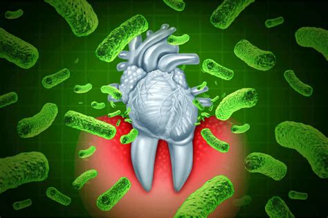 Signs Tooth Infection Has Spread To Heart Mn Heart