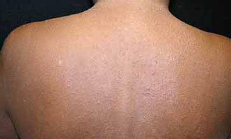 Scielo Brasil Htlv 1 Associated Infective Dermatitis And Probable