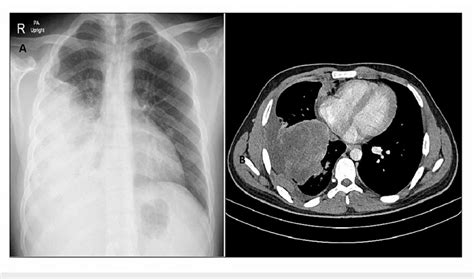 A Chest X Ray Right Middle And Lower Lobe Mass With Rightsided