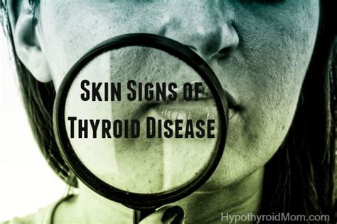 Skin Signs Of Hypothyroidism And Hyperthyroidism