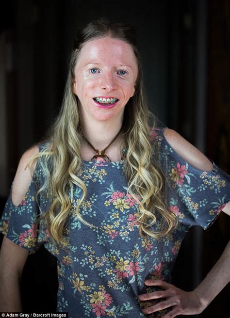 California Woman With Craniofacial Disorder Embraces Look Daily Mail