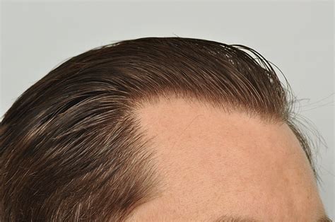 Hair Transplant Hairlines The Complete Guide Forhair