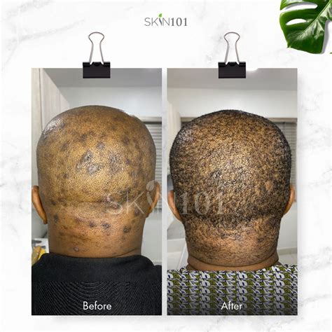 Scalp Folliculitis Treatment Before And After