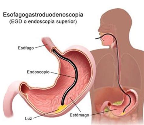 Que es la Esofagogastroduodenoscopia Endoscopia Digestiva Alta o Superior Dr René Reyes Vázquez