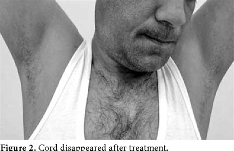 Figure 1 From A Rare Cause Of Shoulder Pain Axillary Web Syndrome