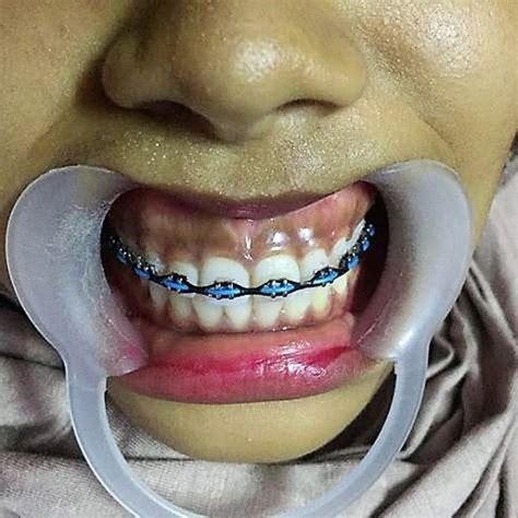 Pin By John Beeson On Orthodontic Braces In Orthodontics Braces