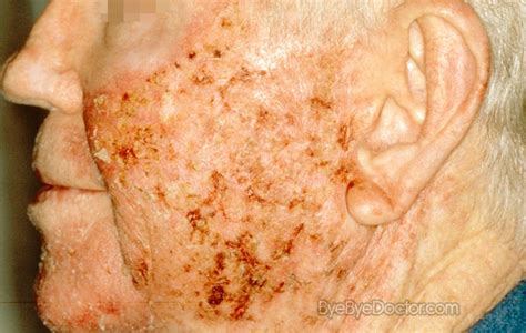 Actinic Keratosis Pictures Symptoms Causes Treatment And Prevention