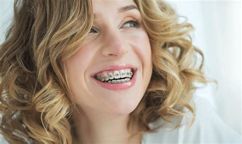 Enhancing Smiles With Style The Beauty Of Ceramic Braces