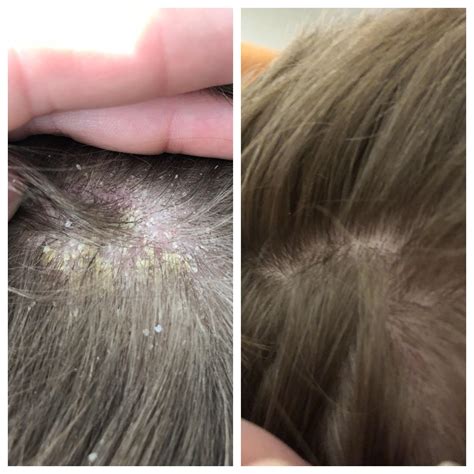 Difference between dandruff and dry scalp