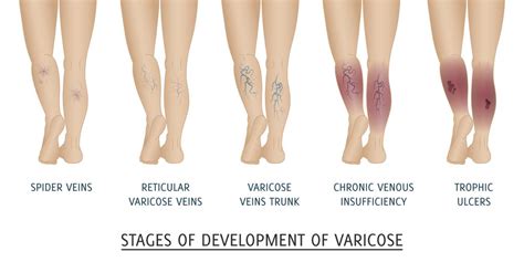 Vein Stasis Dermatitis Overview Causes Symptoms Treatment