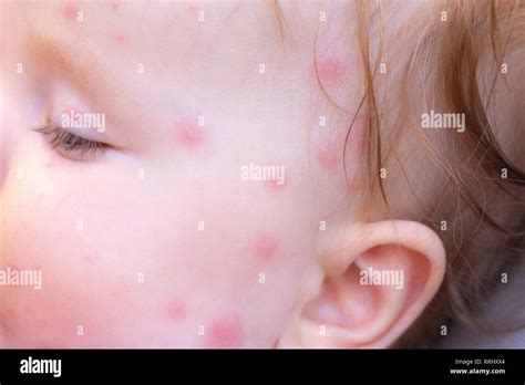 Mosquito Bite Face High Resolution Stock Photography And Images Alamy