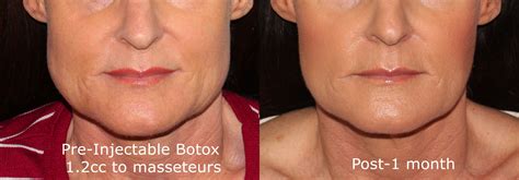Groffbotoxmasseterinjectionswrinklereduction Botox Botox