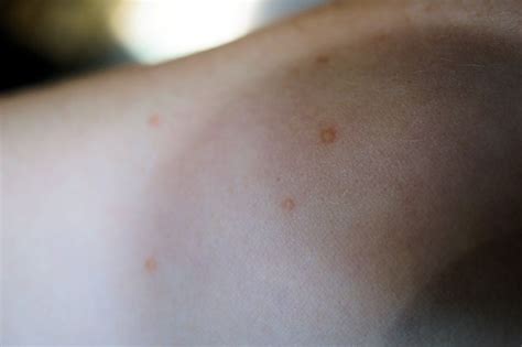 Cluster Of Blister Like Bumps At Skin Cancer Forum With Image Embedded