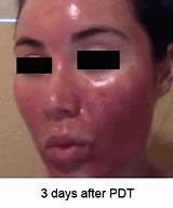Photos of Blue Light Skin Treatment Side Effects