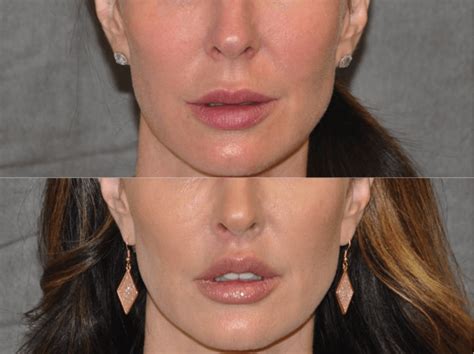 The Lip Lift Is A Cosmetic Surgery That Enhances The Look Of The Entire Face Our Doctors Are