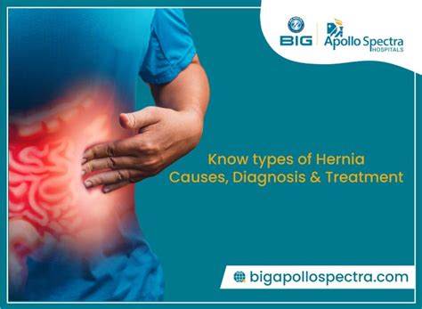 Hernia Types Causes Diagnosis And Treatments