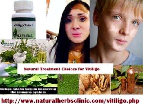 Vitiligo Natural Home Remedies Natural Home Remedies
