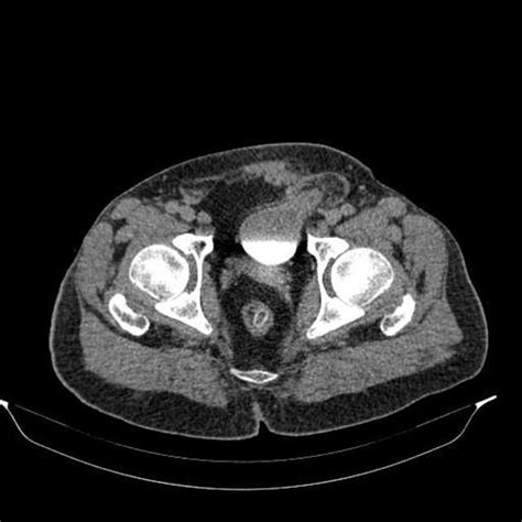 Urinary Bladder Hernia Radiology Case Radiology