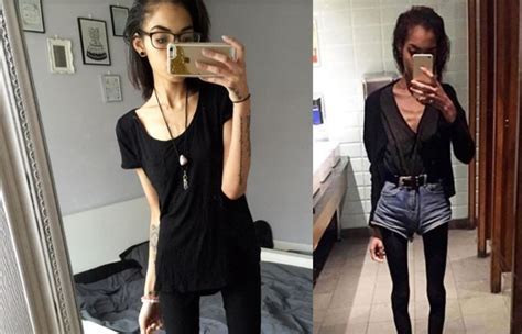 Emisoras Unidas Fotos Víctima De Anorexia Narra Cómo Logró Superarlo