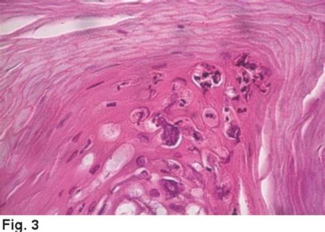 Figure 3 From Acrodermatitis Continua Of Hallopeau A Case With Lesions