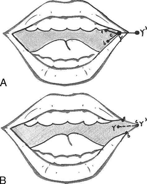 Diagrams Of The Surgical Procedure A Outline Of Proposed Flap Design