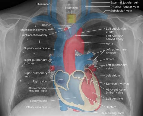 Anatomy Of Chest X Ray X Thorax Startradiology Hot Sex Picture