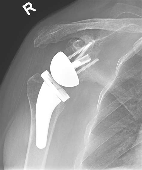 Shoulder Joint Replacement Orthoinfo Aaos