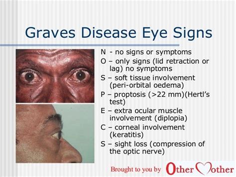Thyroid Eye Disease Graves Disease Graves Disease Eyes Thyroid Disease