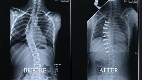 Health Watch Scoliosis Braces For The Spine Abc30 Fresno