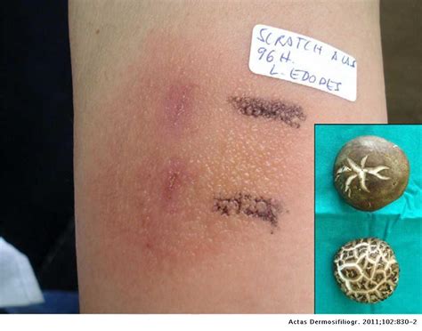 Flagellate Dermatitis After Eating Shiitake Mushrooms Actas Dermo