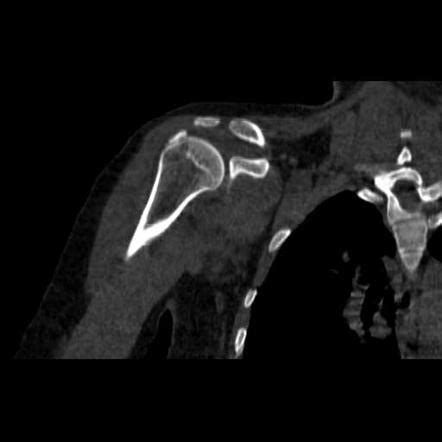 Calcific Tendinitis Radiology Reference Article Radiopaedia Org