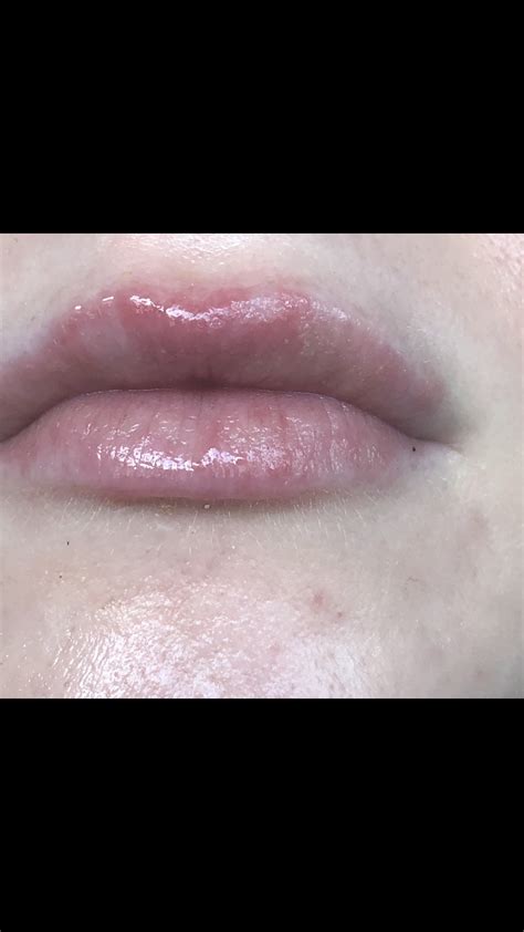 Help Lip Dermatitis Flare Ups For 8 Months Rperioraldermatitis