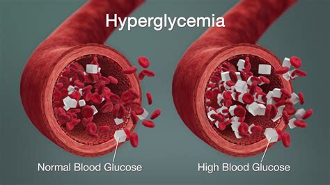 High Blood Glucose