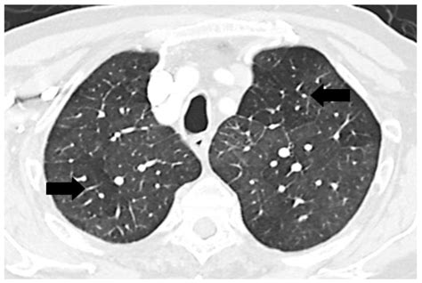 Diseases Free Full Text Mosaic Pattern Of Lung Attenuation On Chest