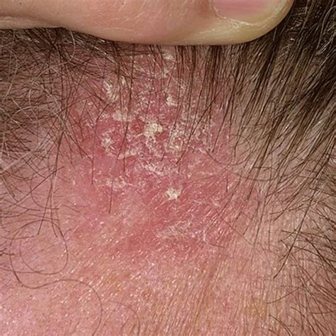 Seborrheic Dermatitis Scalp Hair Loss