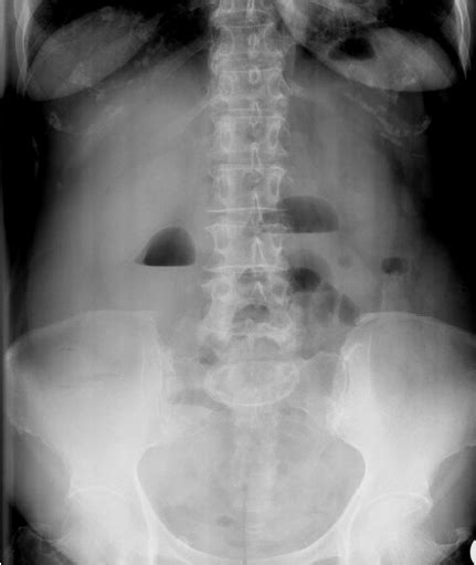 Plain Abdominal Radiography Showing Air Fluid Levels Indicative Of