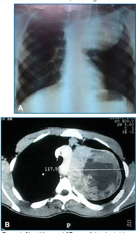 Figure 1 From Primary Biphasic Synovial Sarcoma Presenting As A Lung