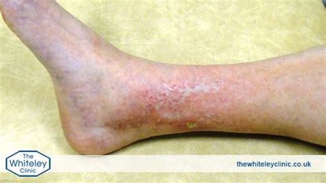 Symptoms Of Phlebitis The Whiteley Clinic