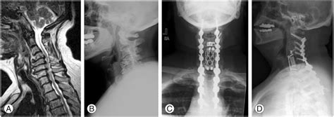 Osteotomies In The Cervical Spine