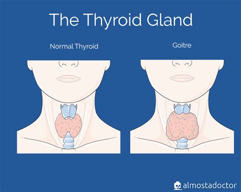 Multinodular Thyroid