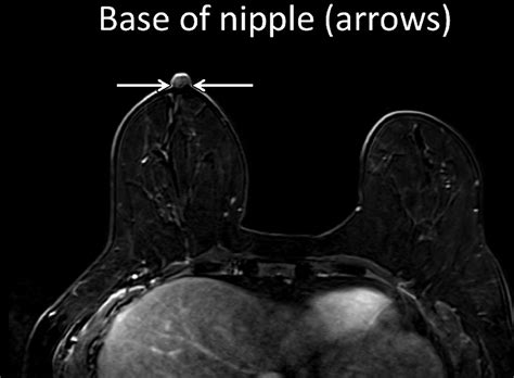 An Analysis Of Nipple Enhancement At Breast Mri With Radiologic Pathologic Correlation